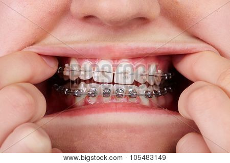 Teeth with orthodontic brackets. Dental health care.