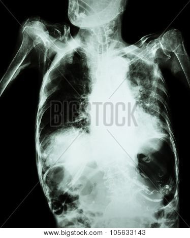 Pulmonary Tuberculosis with acute respiratory failure ( Film chest x-ray of old patient show alveolar and interstitial infiltration both lung with endotracheal tube ) due to mycobacterium tuberculosis