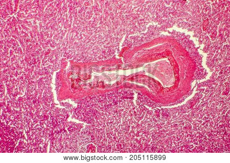 Hyaline degeneration of splenic artery, light photomicrograph