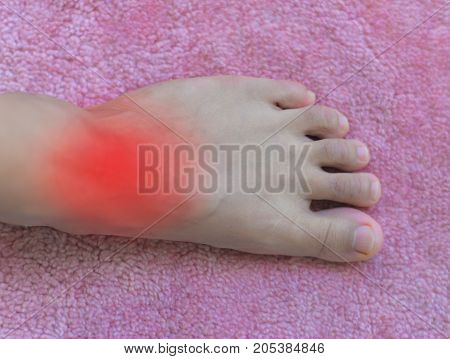 Foot of gout patient.Close up Painful and inflamed gout.