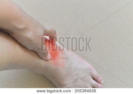 Painful And Inflamed Gout..