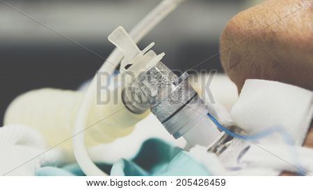 Patient Do Tracheostomy And Ventilator In Hospital