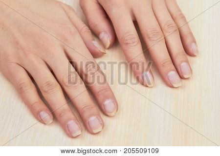 Woman hands after removing gel. Female hands ready for treatment and manicure on salon table. Skin therapy and nails care.