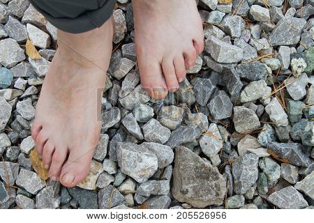 Natural Physiotherapy For Flat Feet. Female Feet On The Surface Of Break Stone As Prevention  Agains