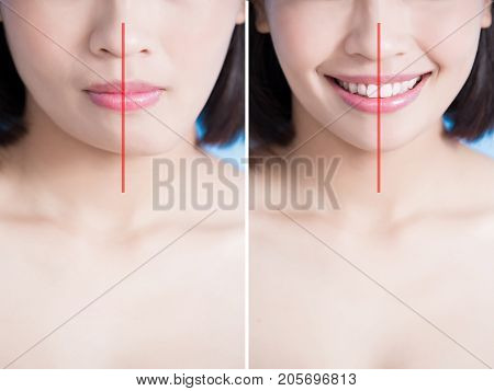 close up of surgery woman asymmetry chin before and after on the blue background