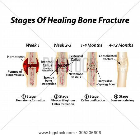 Stages Of Healing Bone Fracture. Formation Of Callus. The Bone Fracture. Infographics. Illustration 