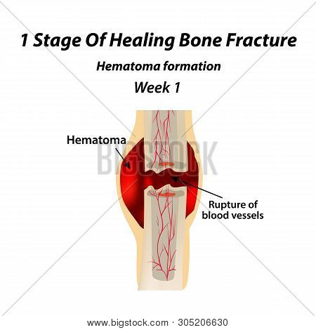 1 Stage Of Healing Bone Fracture. Formation Of Callus. The Bone Fracture. Infographics. Illustration