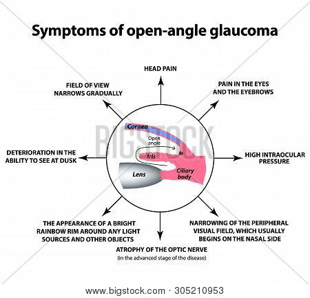 Symptoms Of Open-angle Glaucoma. World Glaucoma Day. The Anatomical Structure Of The Eye. Infographi