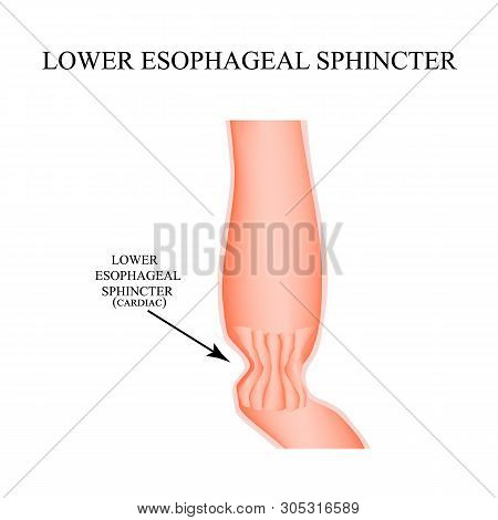 Lower Cardiac Esophageal Sphincter. Infographics. Illustration On Isolated Background.