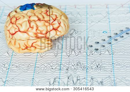 Human Brain Model And Subdural Electrode Recording Brain Waves On Background Of Brain Waves From Ele