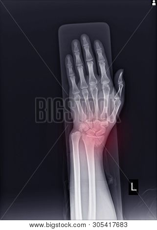 X-ray Left Wrist Joint Fracture With Displacement Distal End Left Radius.soft Tissue Swelling.