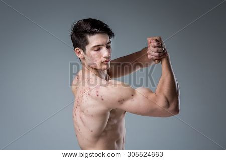 Studio Portrait Young Caucasian Man On Gray Background Posing. Theme Of Puberty, Problem Skin, Teen 