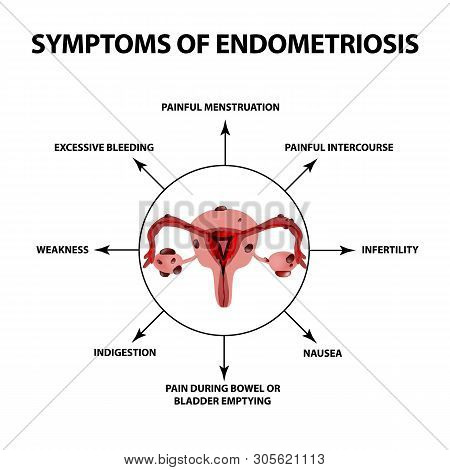 Symptoms Of Endometriosis. The Uterus Ovaries Structure. Infographics. Illustration On Isolated Back
