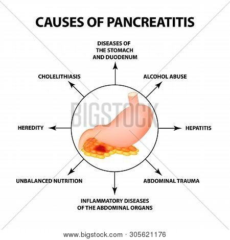 Causes Of Pancreatitis. The Structure Of The Stomach And Pancreas. Infographics. Illustration On Iso