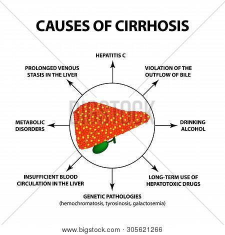 Causes Of Cirrhosis. Infographics. Illustration On Isolated Background.