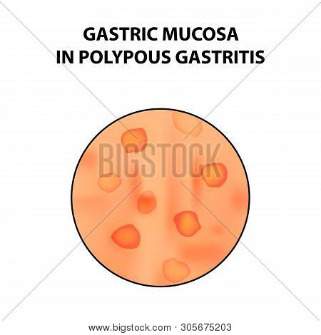 Gastric Mucosa In Polypous Gastritis. Infographics. Illustration On Isolated Background