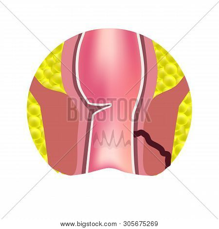 Types Of Fistulas Of The Rectum. Paraproctitis. Anus. Abscess Of The Rectum. Infographics. Illustrat