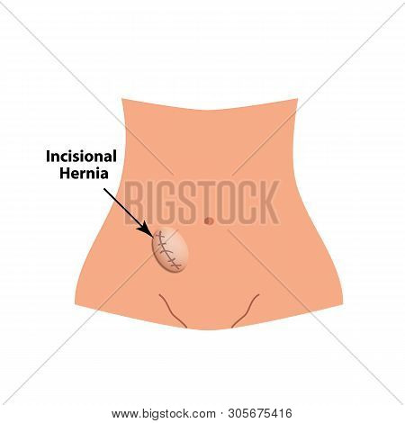 Incisional Hernia. Intestinal Hernia. Infographics. Illustration On Isolated Background.