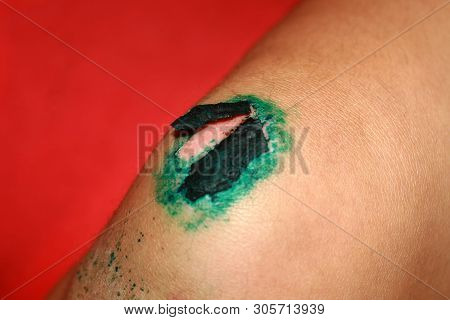 Healing Wound On The Knee. The Wound Treated With Brilliant Green. The Scab Will Climb