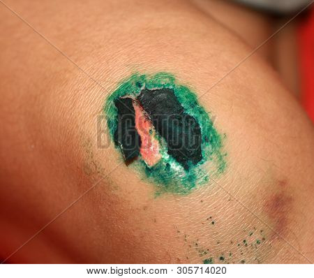 Healing Wound On The Knee. The Wound Treated With Brilliant Green. The Scab Will Climb