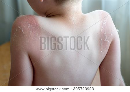 Sunburnt On Skin Around Knee Of Mans Left Leg, Isolated On White Background