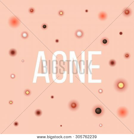 Creative Illustration Types Of Acne, Pimples, Skin Pores, Blackhead, Whitehead, Scar, Comedone, Stag