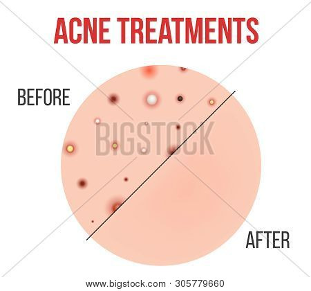 Creative Illustration Types Of Acne, Pimples, Skin Pores, Blackhead, Whitehead, Scar, Comedone, Stag