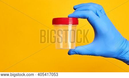 Medical Exam Concept. Perosn Holds Urine Test Cup Over Bright Yellow Background.