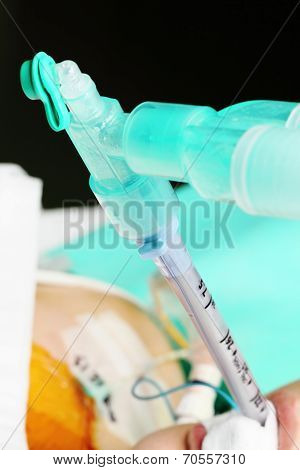 Patient On Artificial Lung Ventilation