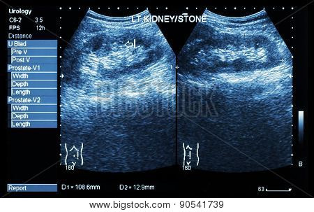 Ultrasonography Of Kidney : Show Left Kidney Stone ( 2 Image For Compare )