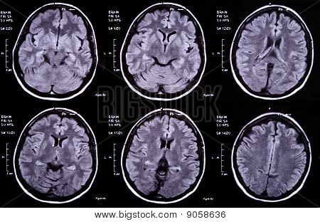 Radiografía del cerebro