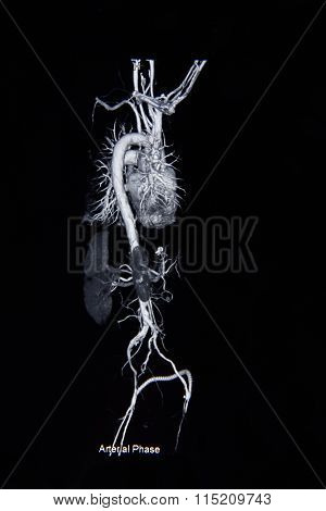 Ct Scan Angiogram (take Photo From Film X-ray)