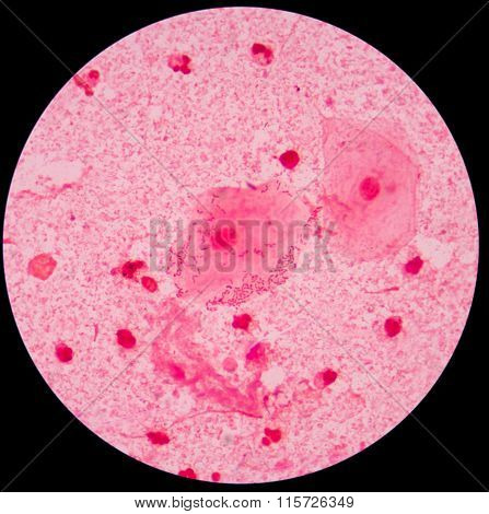 Red Leukocyte In Sputum Gram Stain With Bacteria