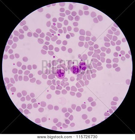 Blood Smear Form Sepsis.septicemia Can Progress To Sepsis.