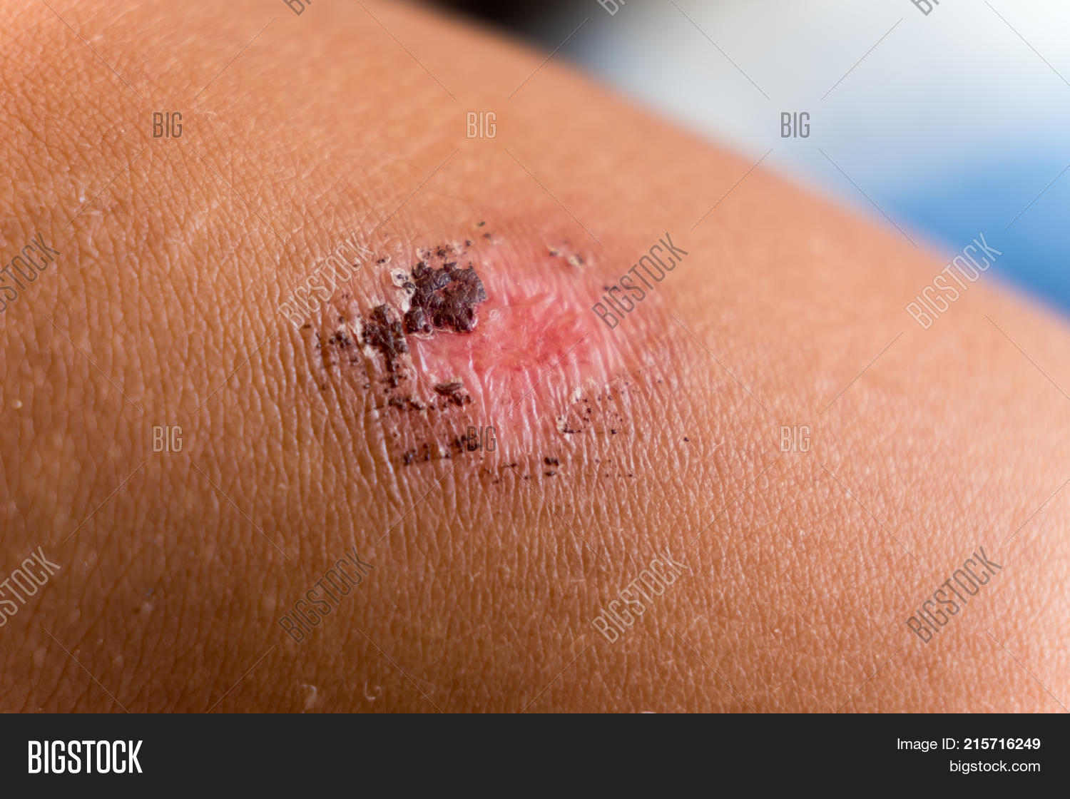 Red Bloody Wound, Image & Photo (Free Trial) Bigstock