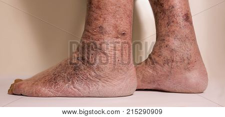 Close-up of skin with varicose veins on senior male leg. Concept of dry skin