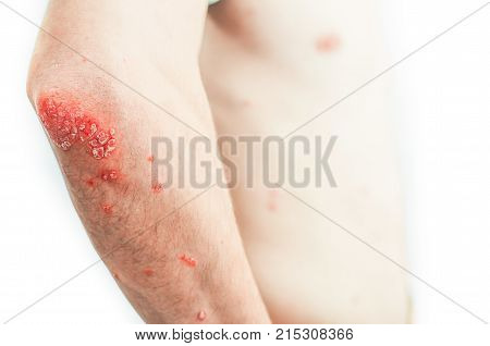 On The Elbows Psoriasis