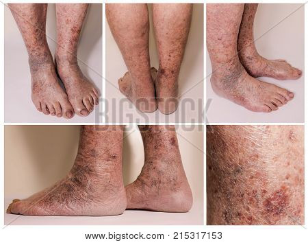 The collage of skin with varicose veins on senior male legs. Concept of dry skin
