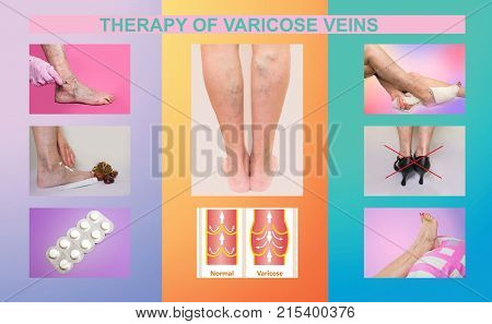 Collage about therapy or treatment of varicose veins