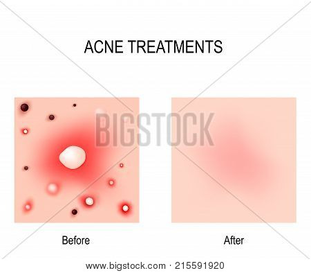 Acne Treatment. Before and after. Skin problems: blackheads whiteheads pimples and oily skin. For skin clear using is cosmetic procedures and diet.