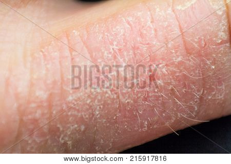 Hand dermatitis. Hand eczema closed on white background