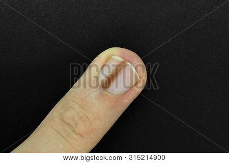 Finger Nail With Melanonychia