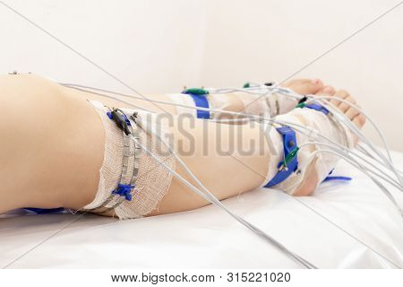 Rheogram Of The Lower Extremities. Patients Legs On Rheovasography. Silver-plated Electrodes Are Con