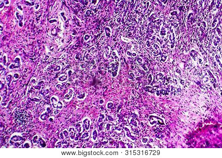 Histopathology Of Biliary Liver Cirrhosis, Light Micrograph, Photo Under Microscope