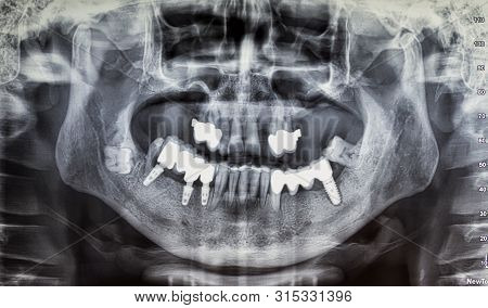 Dental X-ray Of An Adult Patient, Dentistry