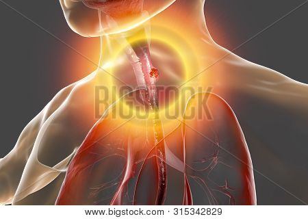 Esophageal Cancer, 3d Illustration Showing Malignant Tumor In The Human Esophagus