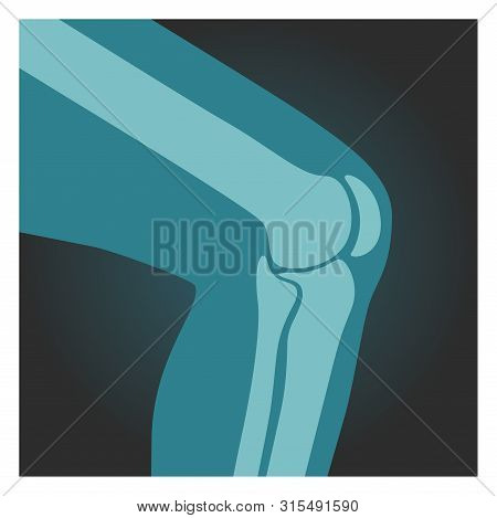 X-ray Shot Of Knee, Human Body, Bones Of Leg, Radiography, Vector Illustration.