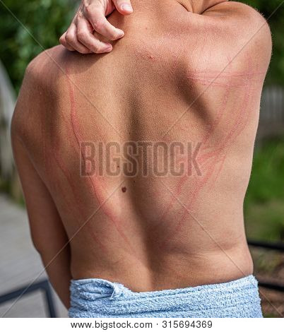 Dermatographic Urticaria (also Known As Dermographism, Dermatographism Or 