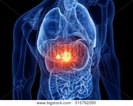 3d rendered medically accurate illustration of liver cancer