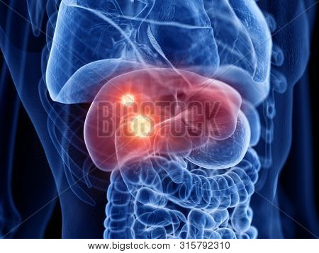 3d rendered medically accurate illustration of liver cancer
